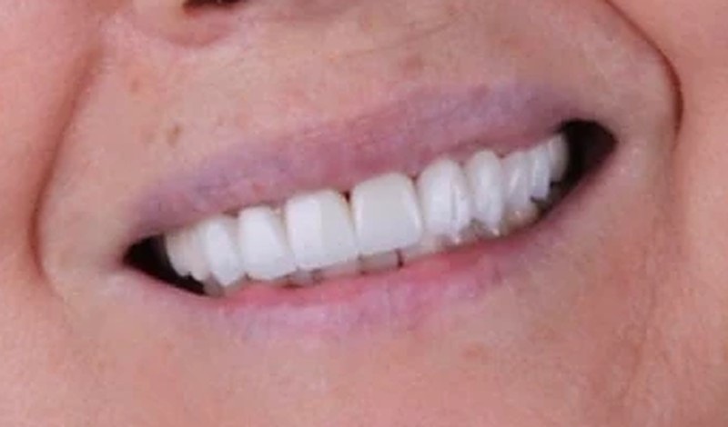 Sonrisa después del tratamiento