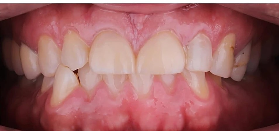 Sonrisa después del tratamiento
