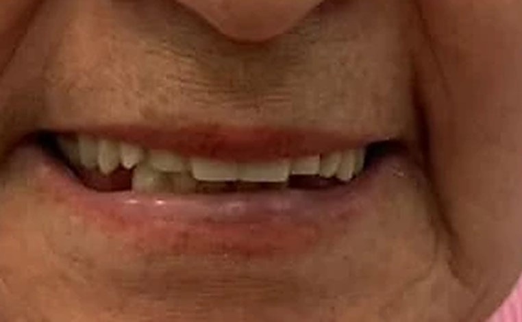 Sonrisa antes del tratamiento